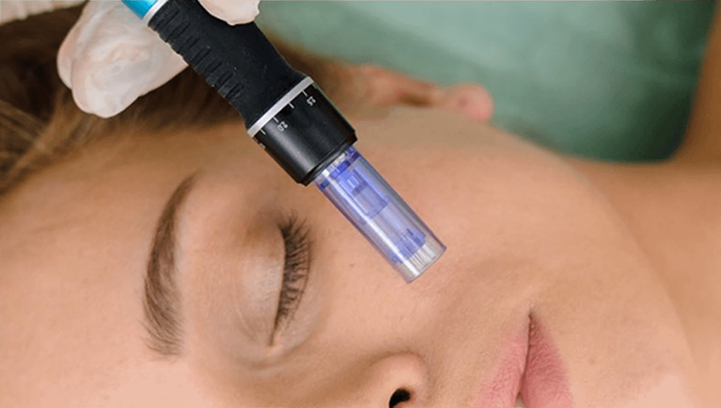 facial_dermapen_exosomas3 1